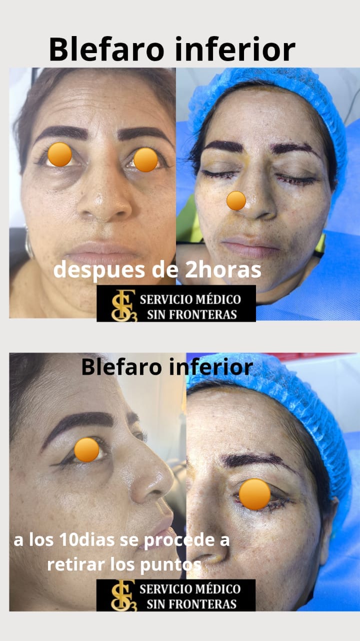 Resultado Blefaroplastia 4